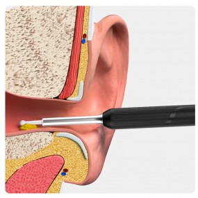 Cure-oreille intelligent sans fil, outil de soins de l'oreille, nettoyage  du conduit auditif, Otoscope, conception Flexible, 360 °, NP20
